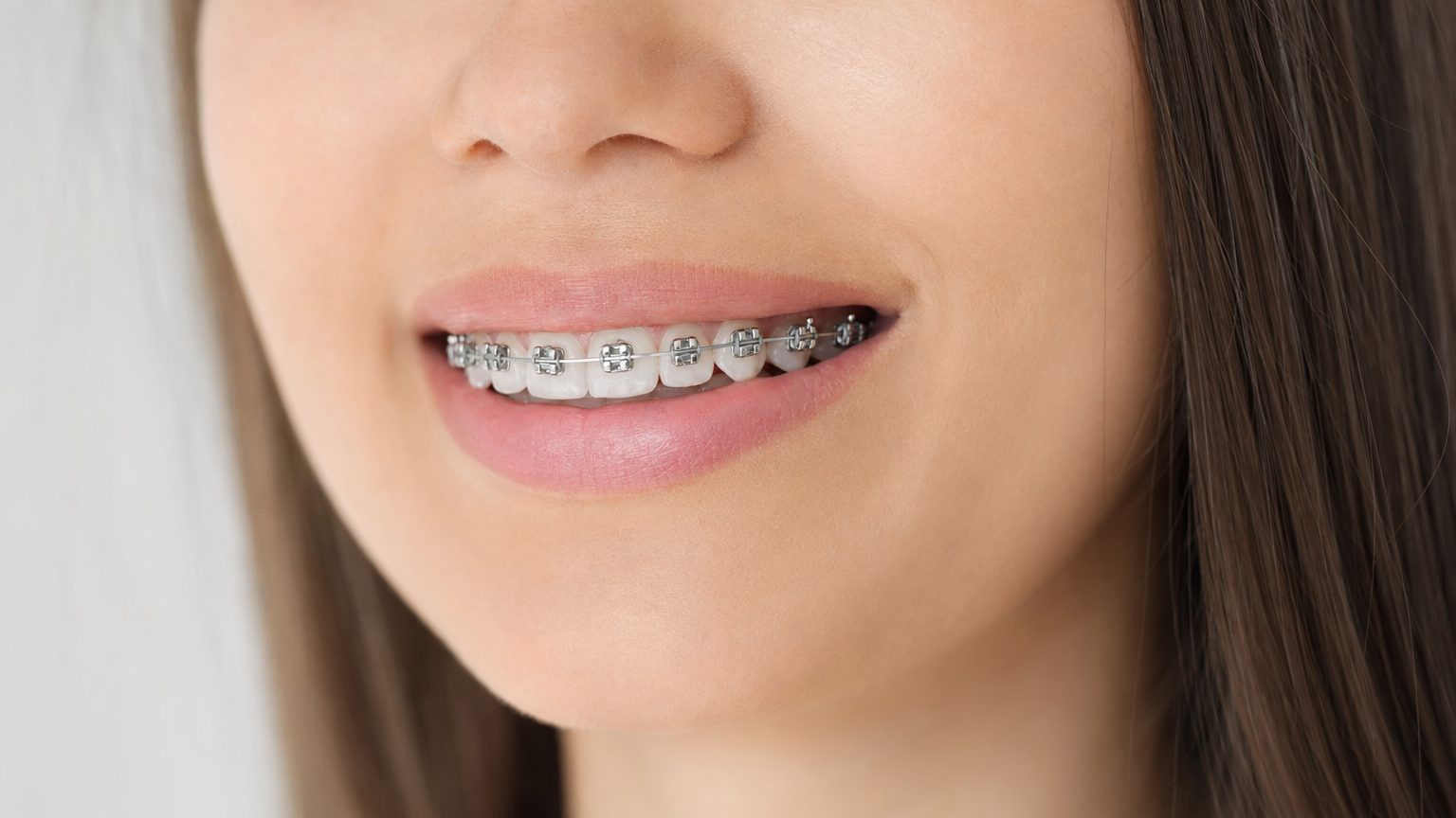 Are Damon Braces Really Better?